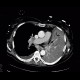 Lung tumour, tumorous infiltration of the lung wing: CT - Computed tomography